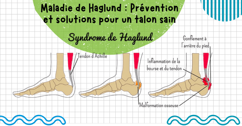 Maladie de Haglund Prévention et solutions pour un talon sain